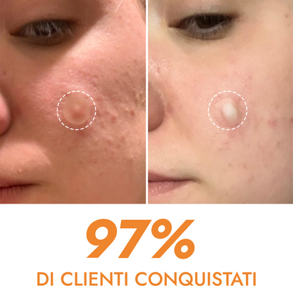 Cerotti anti-brufoli e anti-acne