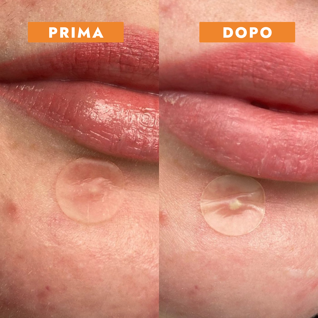 Cerotti anti-brufoli e anti-acne